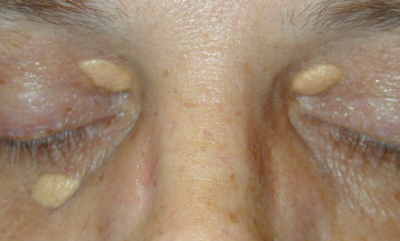 Natural Cures For Cholesterol And Skin Natural Cures For Cholesterol And Skin