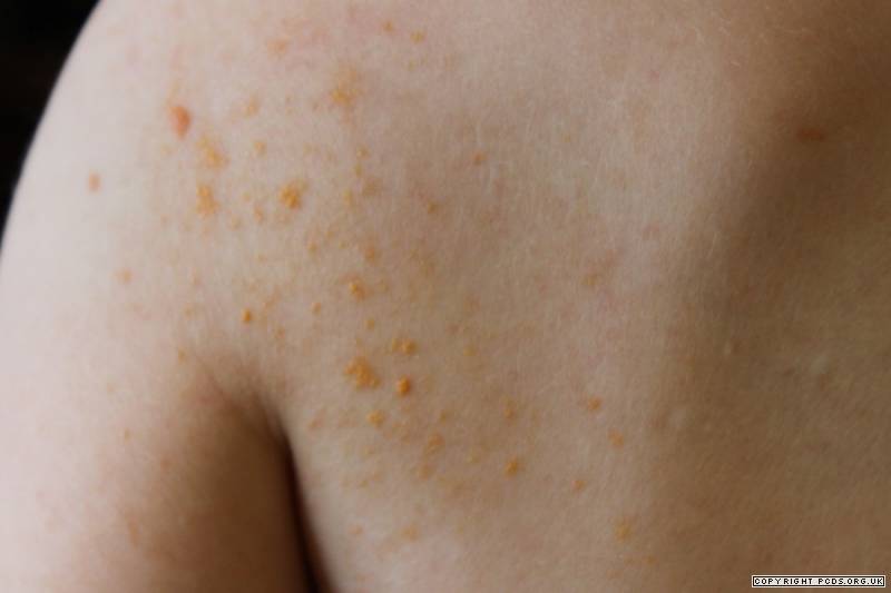 Xanthoma Types, Symptoms, Causes And Risk Factors