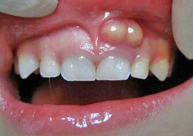 Natural cures for tooth abscess
