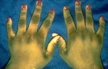 Acanthosis Nigricans