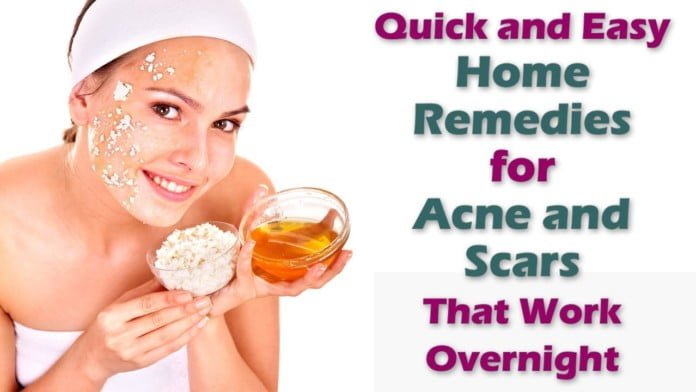acne home remedy
