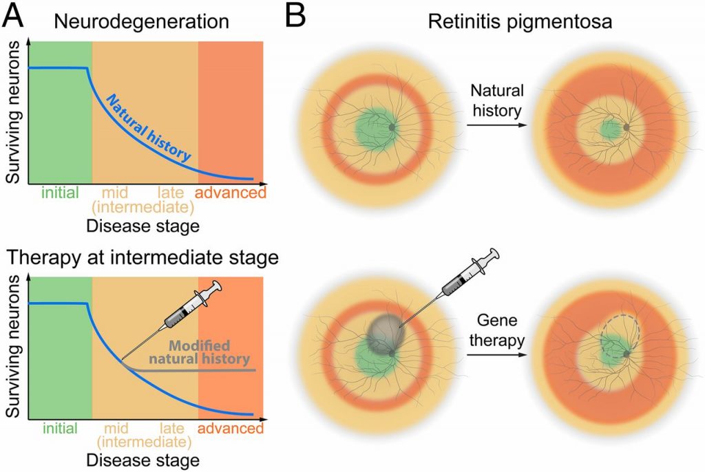 acupuncture for retinitis pigmentosa