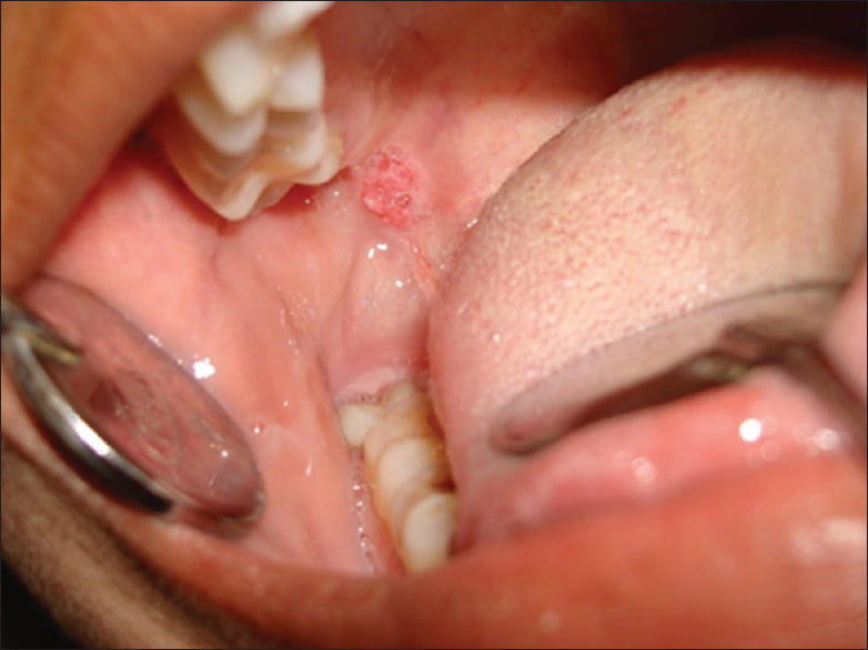 adenoid cystic carcinoma slideshare