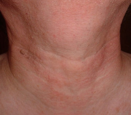 Throat Cancer: Basic 7 Symptoms And Causes Throat Cancer