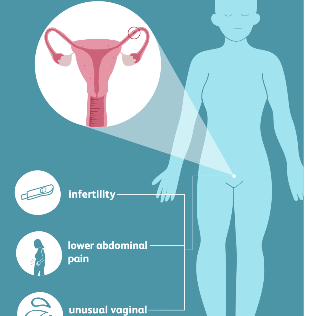 Blocked Fallopian Tubes Some Basic Symptoms And Causes