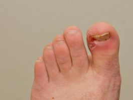 Natural cures for ingrown nails