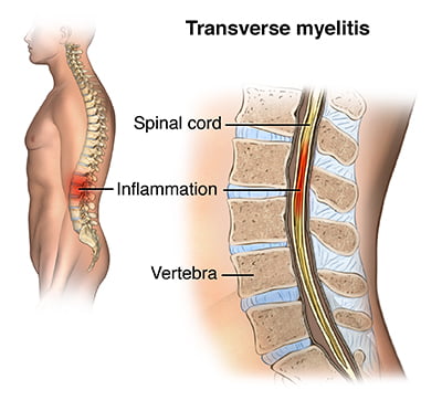 Transverse Myelitis