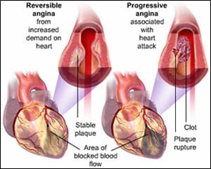 Angina - symptoms, causes and its associated risk factors angina