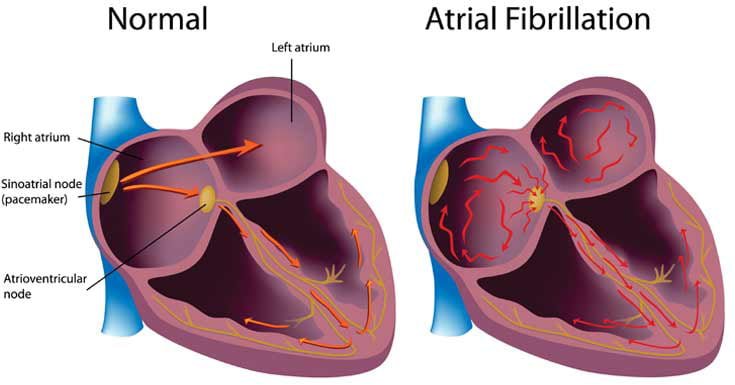 atrial fibrillation