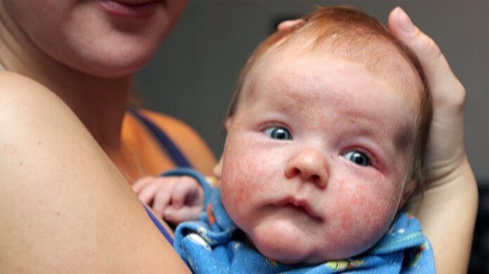 symptoms of baby eczema
