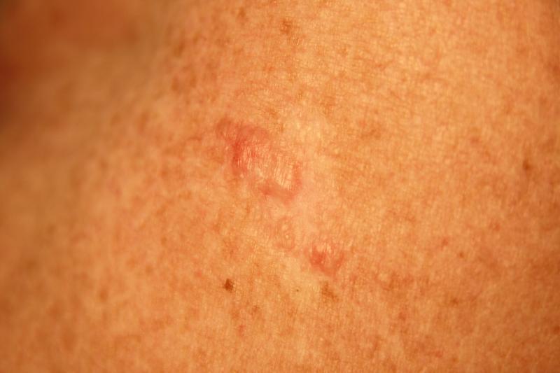basal cell carcinoma home remedy