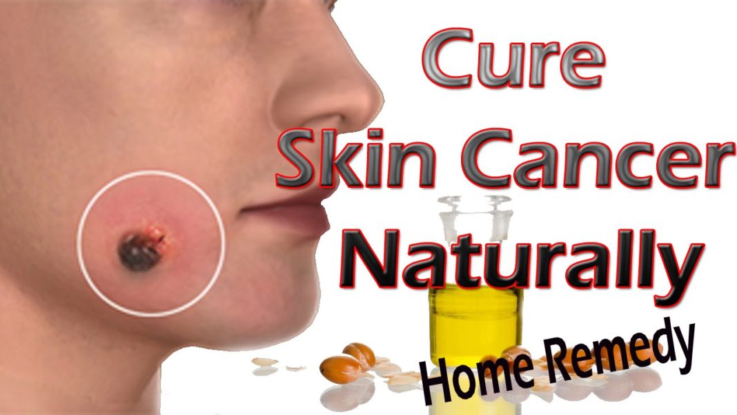 Basal Cell Carcinoma Home Remedy and other natural treatment