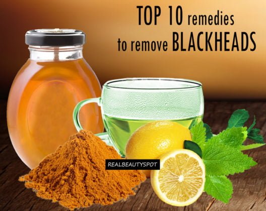 Picture of Blackheads - How To Get Rid Of Them Effectively And Naturally?