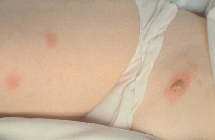 blastomycosis skin
