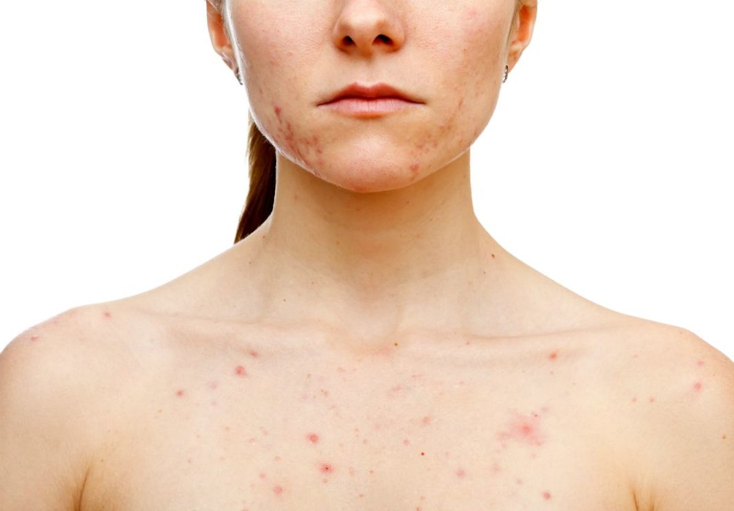 body acne types causes symptoms