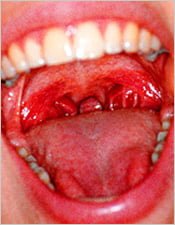Natural cures for burning mouth syndrome