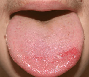 burning tongue syndrome