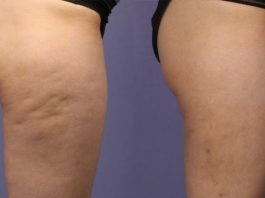 can you get rid of cellulite once you have it