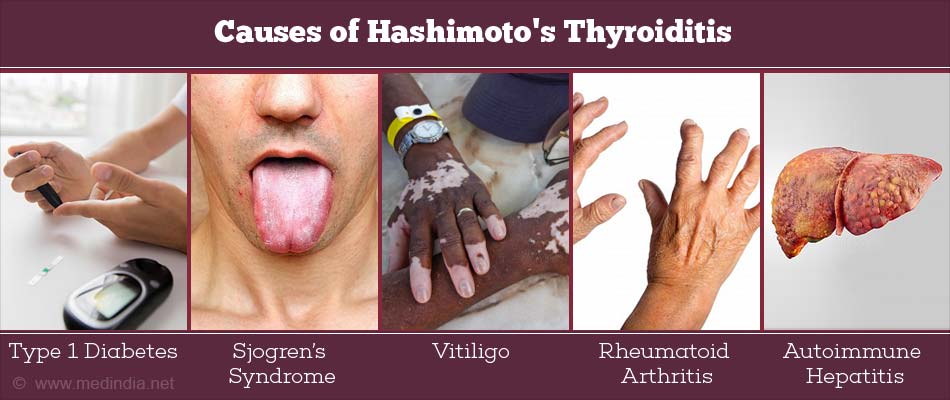 hashimoto's thyroiditis