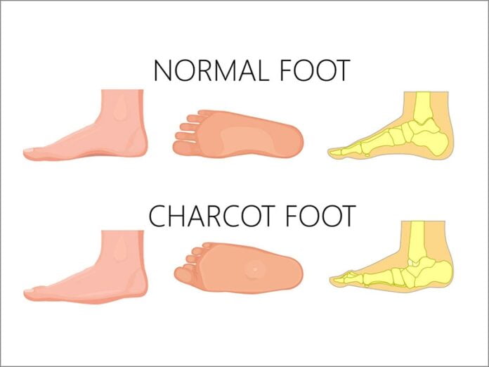 Charcot's joint