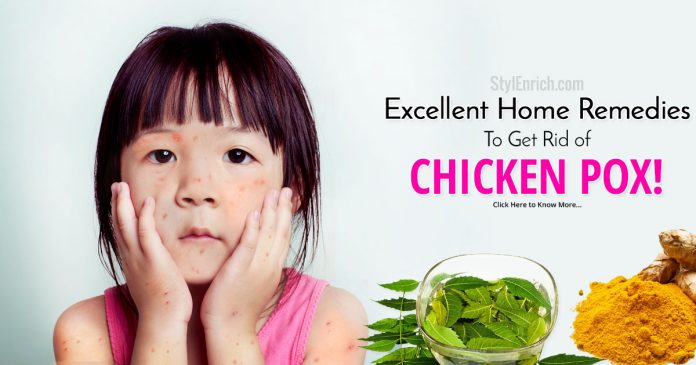 chickenpox treatment home remedy