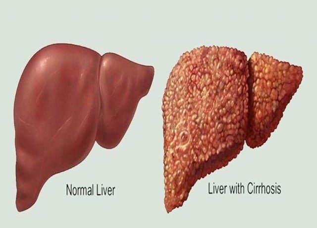 Fatty liver