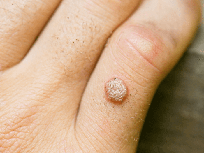 common warts treatment