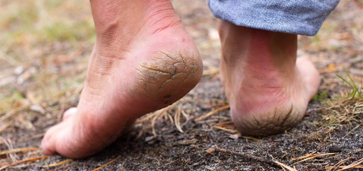 How to heal cracked heels naturally through home remedies