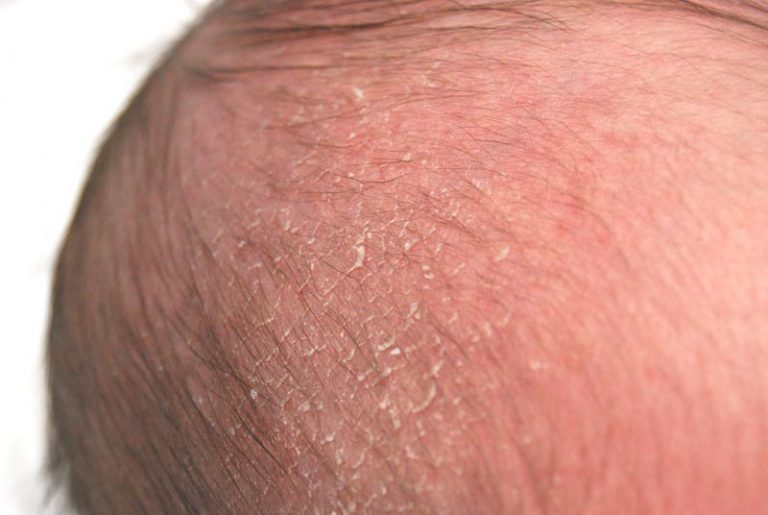Cradle Cap Causes, Symptoms And Other Related Information