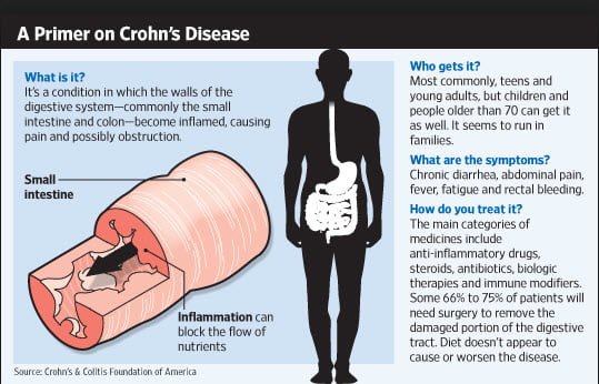 crohns disease symptoms causes