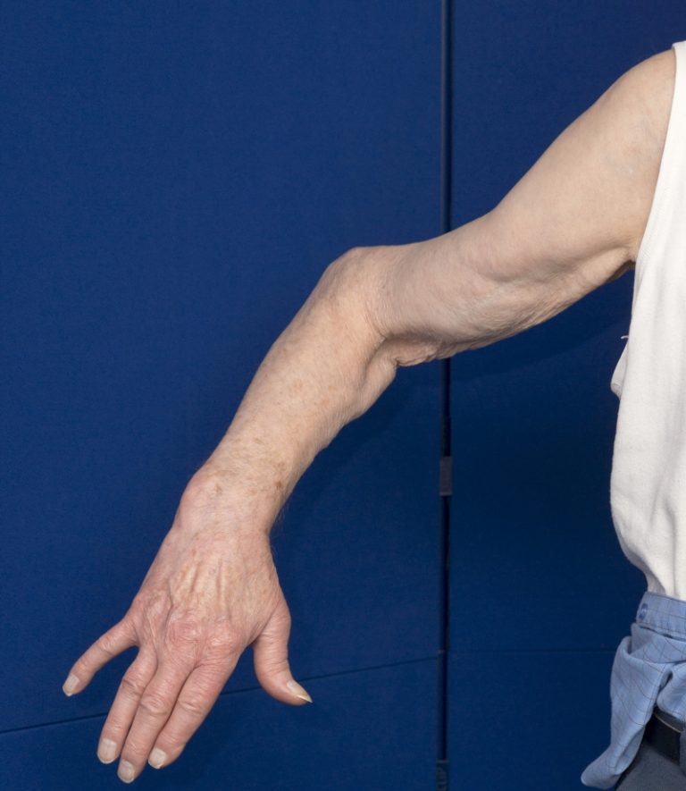 Natural Treatments For Paget's Disease Of Bones