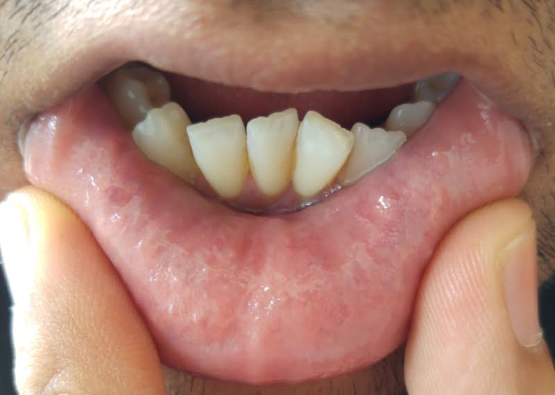 Aloe Vera Gel Is A Very Effective Home Remedy For Oral Herpes