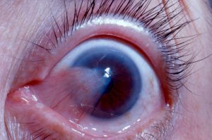 Natural cures for pterygium