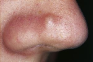 Natural cures for skin lesions