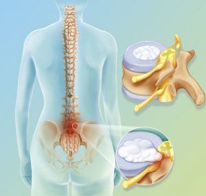 Natural cures for slipped disc