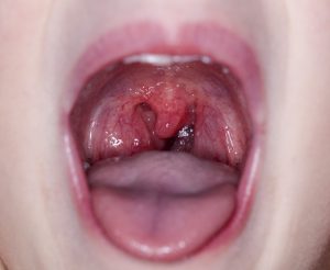 cures for tonsil stones
