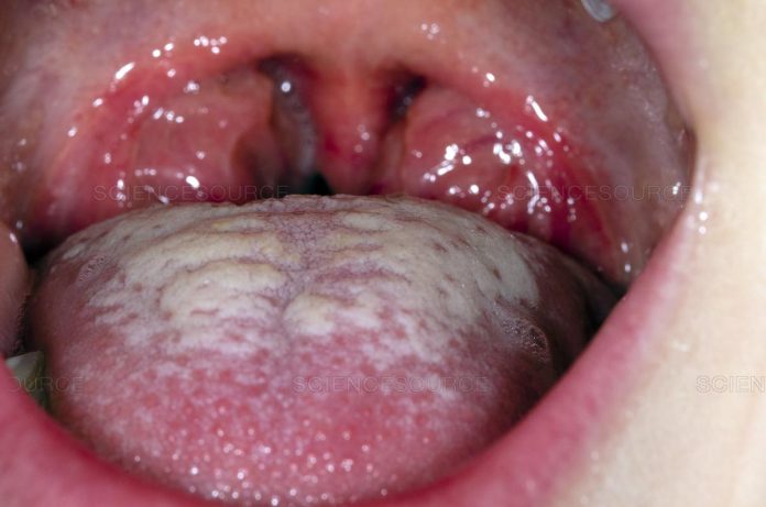 Natural cures for tonsillitis