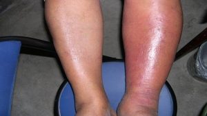 cellulitis natural treatment