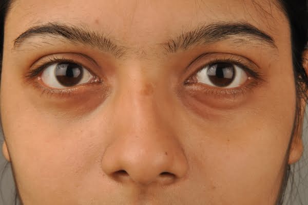 Dark circles under eyes