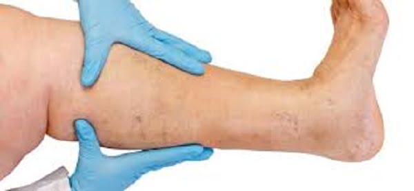 deep vein thrombosis prevention