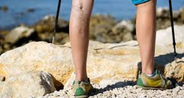 16 Home Remedies for Deep Vein Thrombosis