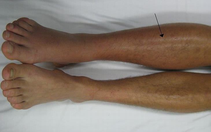 16 Home Remedies for Deep Vein Thrombosis deep vein thrombosis treatment walking