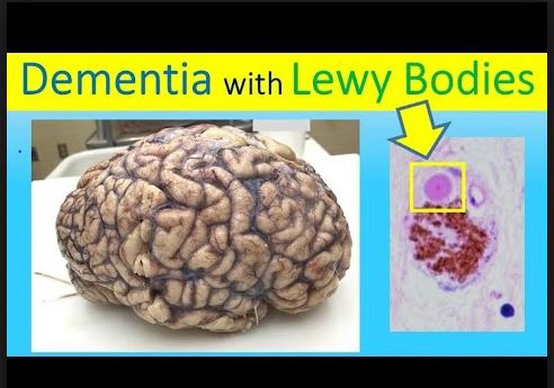 dementia with lewy bodies causes