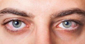 Dry eyes