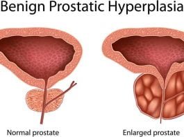 enlarged prostate symptoms