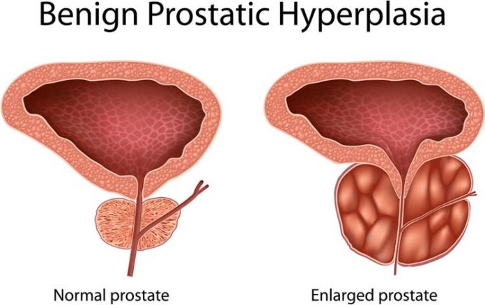 enlarged prostate symptoms