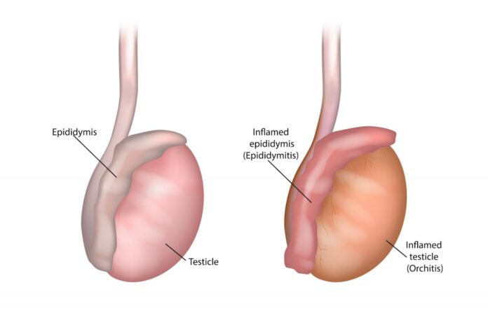 epididymitis lump