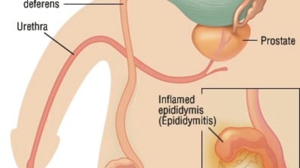 epididymitis ultrasound