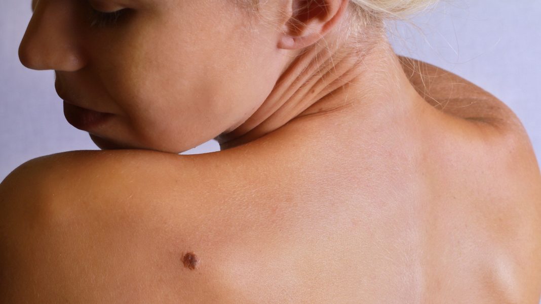 Natural treatment for seborrheic keratosis Natural treatment for seborrheic keratosis