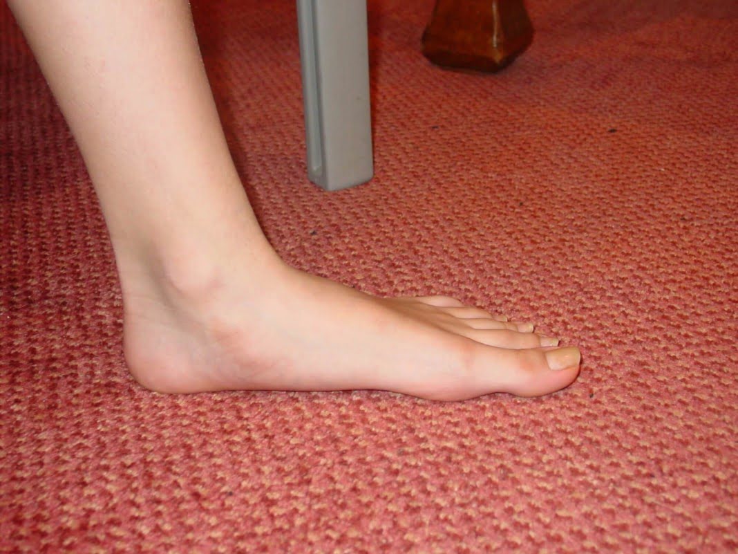 How to manage naturally and overcome the flat feet problem
